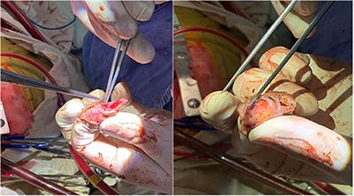 Pericardial Effusion During the Perioperative Period for Left Atrial Appendage Closure